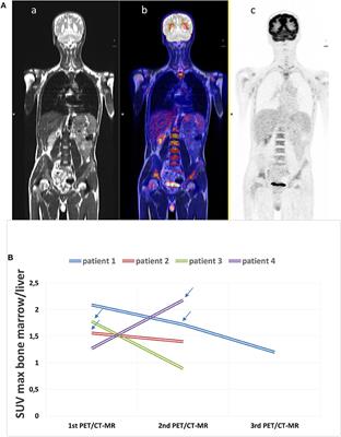 18F-Fluorodeoxyglucose Positron Emission Tomography and Computed Tomography With Magnetic Resonance for Diagnosing Adult-Onset Still's Disease